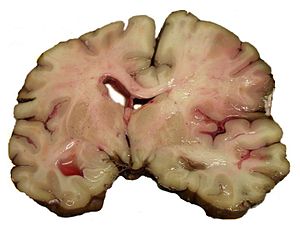 Photograph of acute MCA stroke. Image taken at...