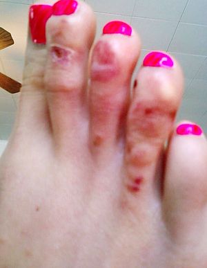 English: Vesicular Athlete's Foot