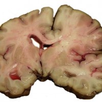 MCA-Stroke-Brain-Human-2
