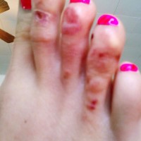 Tinea_pedis_1319